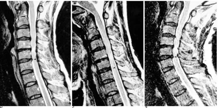 Table 5. Measurements of AP Diameter of Spinal Canal Disks Neutral  Flexion  Extension C2-3 10.99±1.40 10.86±1.48 10.86±1.36  C3-4 10.05±1.48 10.06±1.47  09.44±1.51*  C4-5  09.56±1.41 10.12±1.22*  09.17±1.35*  C5-6  09.22±1.10 10.23±0.95*  08.52±1.33*  C6-