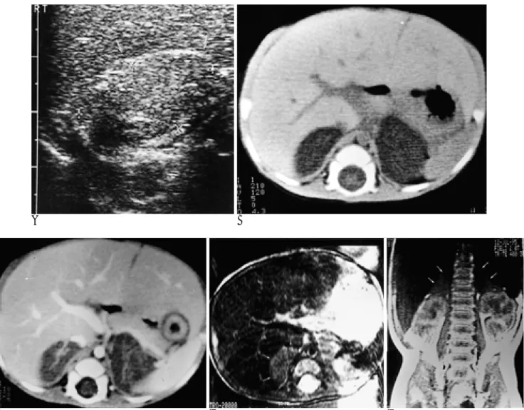 Fig. 1. Imaging features of CLAH in a 4-day-old female neonate. 