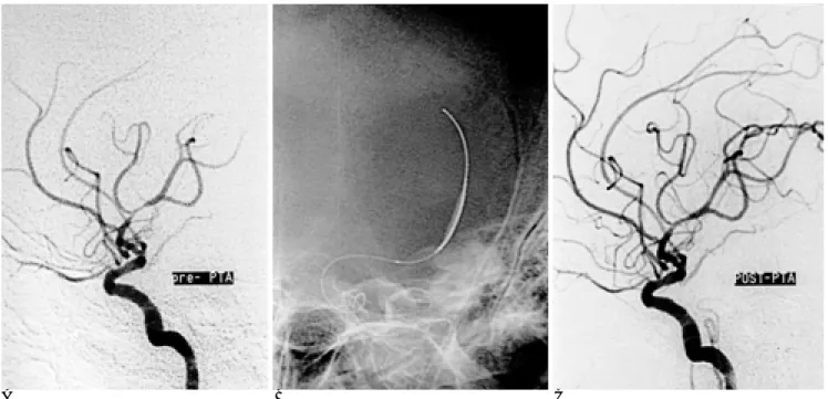 Fig. 3. A 75-year-old woman with right motor weakness and aphasia.