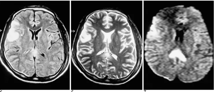 Fig. 3. Diffuse axonal injury in 34-year-old man.