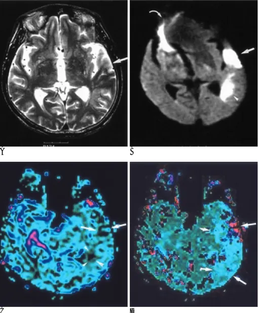 Fig. 2. A 71-year old man with acute in- in-farction. MR images were obtained 18 hours after symptom onset