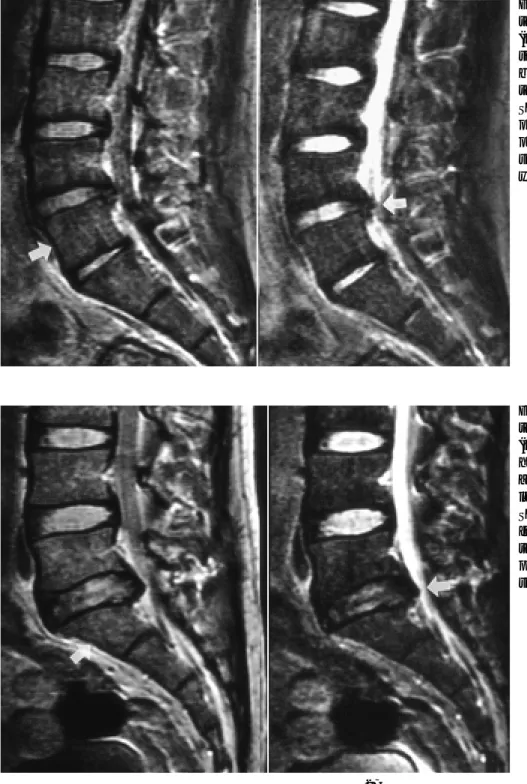Fig. 2. 23-year-old man of Type IIa ver- ver-tebral hypoplasia between L4 and L5.
