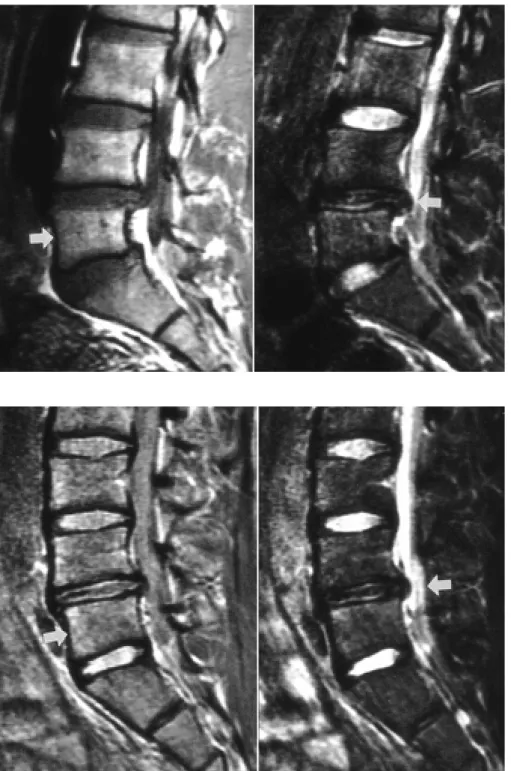 Fig. 4. 27-year-old man of Type Ia ver- ver-tebral hypoplasia involving L5  verte-bral body