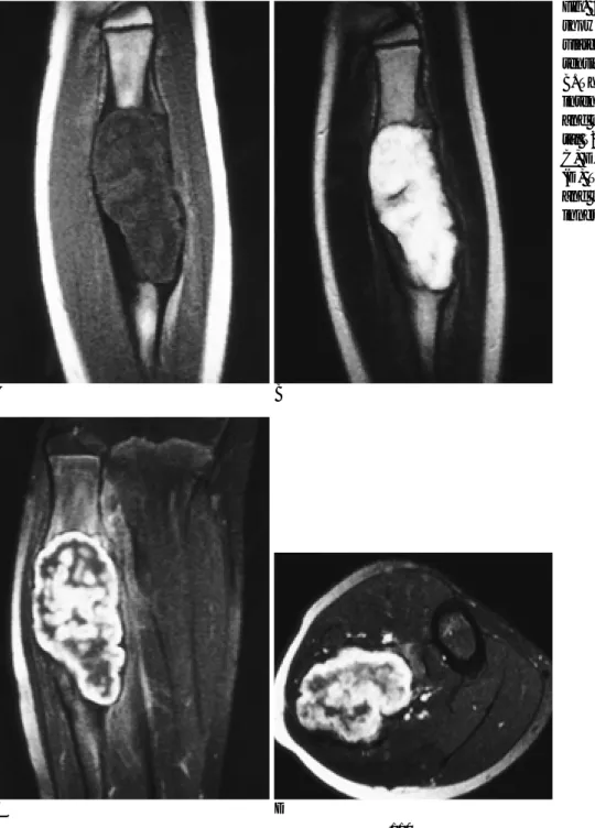 Fig. 2. A. Sagital T1 weighted image shows an elongated, expanded and  lob-ulated lesion of relatively low signal  in-tensity in the proximal of fibula.