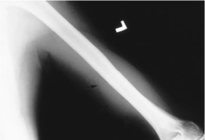 Fig. 1. The plain film shows a relatively well-defined soft tissue density mass lesion in the left upper arm (arrow)