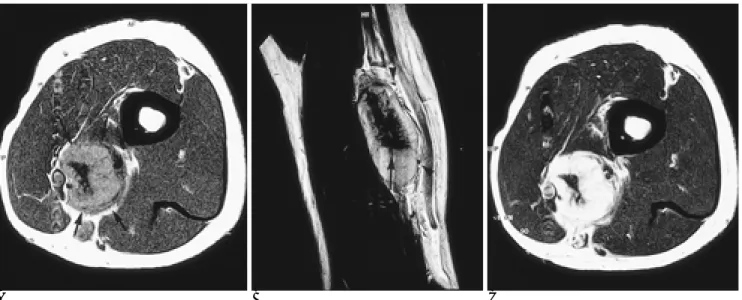Fig. 4. Microscopic findings show marked lymphoid prolifera- prolifera-tion with distinct germinal centers (arrows) which are  pene-trated by centripetal growth of capillaries (curved arrow).