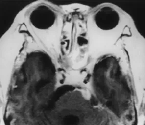 Fig. 4. Case 1 (42/M) with left septic cavernous sinus thrombo- thrombo-sis.