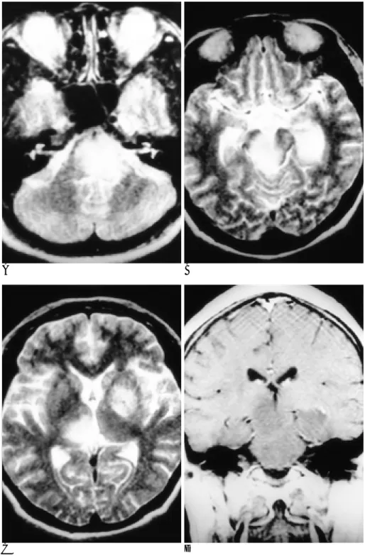 Fig. 1. Case 5. T2-weighted axial im- im-ages (A-C) show poorly defined,  exten-sive high signal intensity neuro-Behcet lesions in pons, midbrain, both side temporal lobes, right thalamus, and left basal ganglia