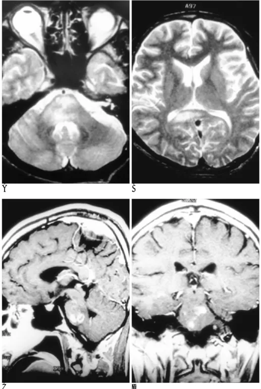 Fig. 2. Case 4. T2-weighted axial im- im-ages (A, B) show high signal intensity lesions in pons and splenium of corpus callosum