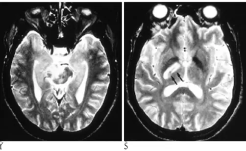 Fig. 1. Multiple parenchymal lesions in the midbrain and the posterior limb of the internal capsule in a 35-year-old man