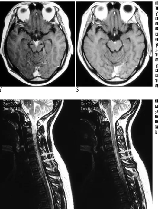 Fig. 4. Spinal cord involvement in a 40- 40-year-old woman.