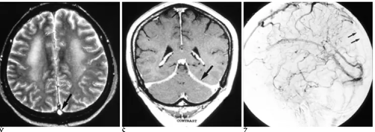 Fig. 6. Microhemorrhage and brain- brain-stem atrophy on follow-up MRI study in a 26-year-old woman.