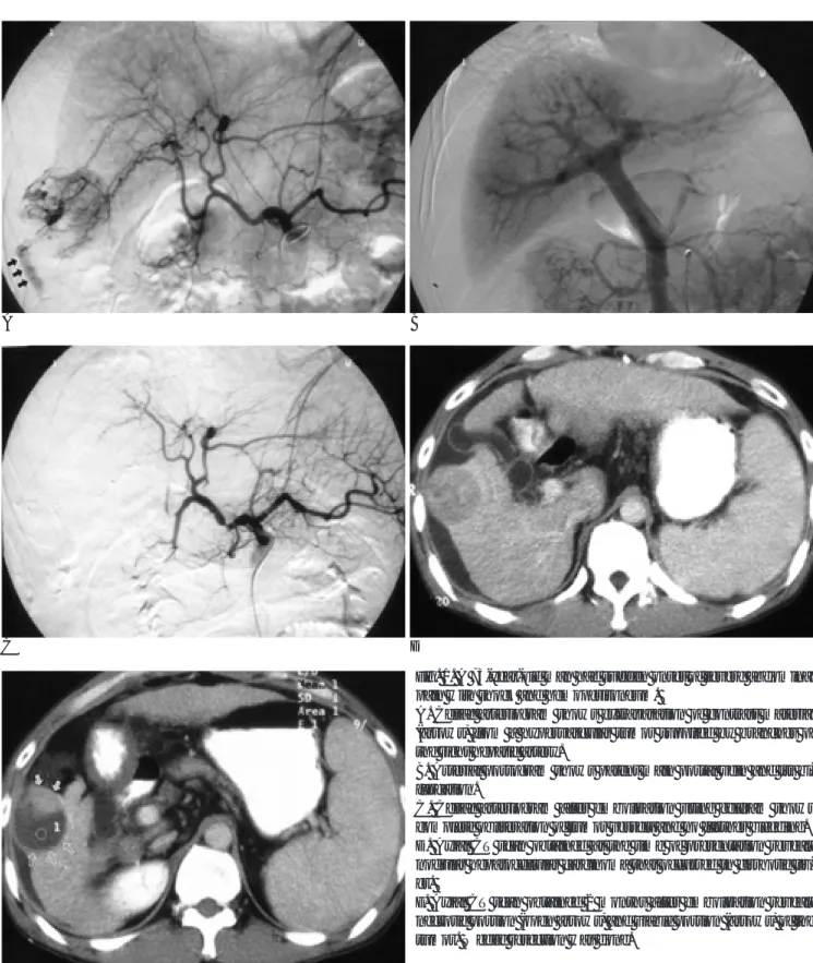 Fig. 1. A 73-year-old man had sudden onset of severe abdominal pain with shock and hemoperitoneum