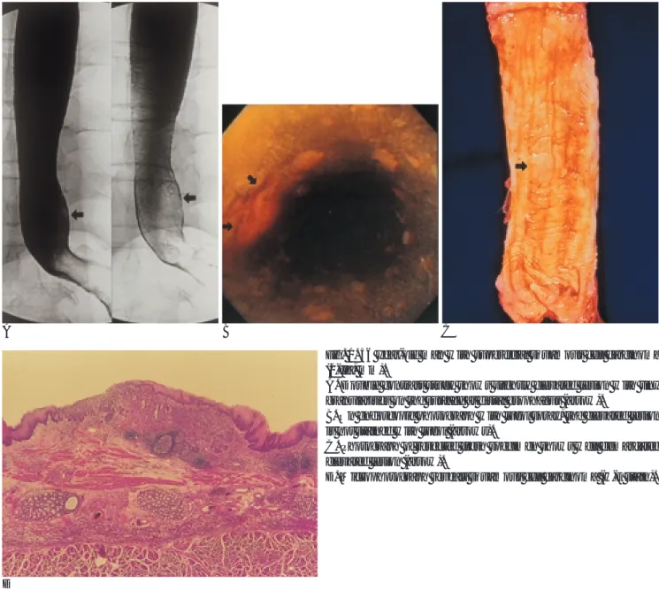 Fig. 1. 56 year-old man with superficial squamous cell carcinoma (0-IIa, mm).