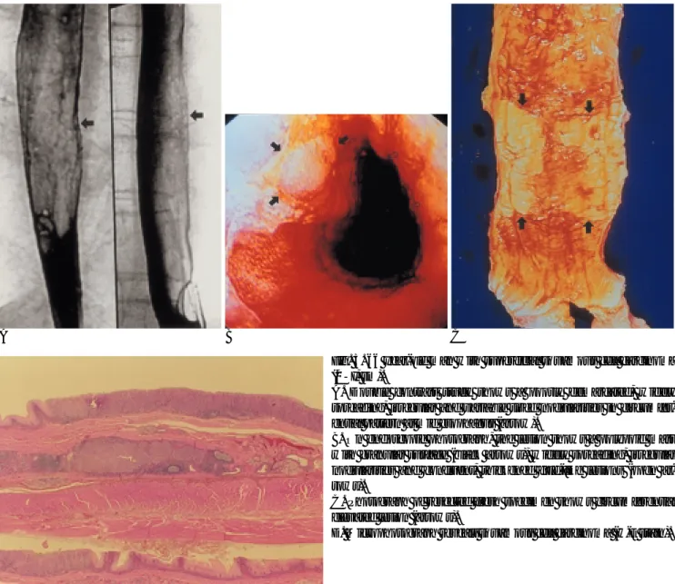 Fig. 3. 66 year-old man with superficial squamous cell carcinoma (0-I, sm).