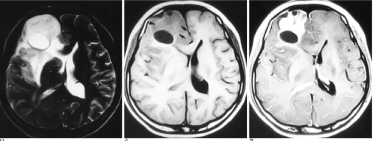 Fig. 1. A. Axial T2-weighted MR image shows a heterogeneous high signal intensity mass containing several cysts of homogeneous bright signal intensity with central higher signal areas in the right frontal lobe.