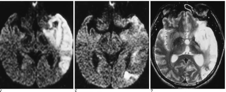 Table 3. Relationship of Time of Initial DWI after Symptom Onset and Change of Lesion Territory on follow-up DWI (n=15)