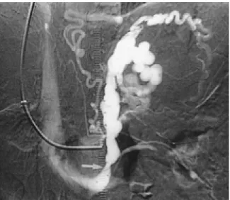 Fig. 2. Angiographic features according to grading of esophageal and gastric varices before TIPS