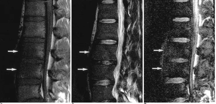 Fig. 3. Pyogenic spondylitis of the L2 and L3 bodies (arrows) in a 22-year-old man. Notice the low signal intensity on the T1-weight- T1-weight-ed image (A) and the high signal intensity on the T2-weightT1-weight-ed image (B)