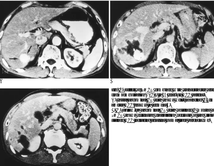 Table 1. Results of Treatment according to HCC Size(n=25)