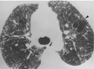 Fig. 1. Forty two-year-old male patient with subacute hyper- hyper-sensitivity pneumonitis