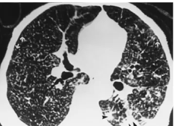 Fig. 3. Sixty nine-year-old female patient with subacute hyper- hyper-sensitivity pneumonitis