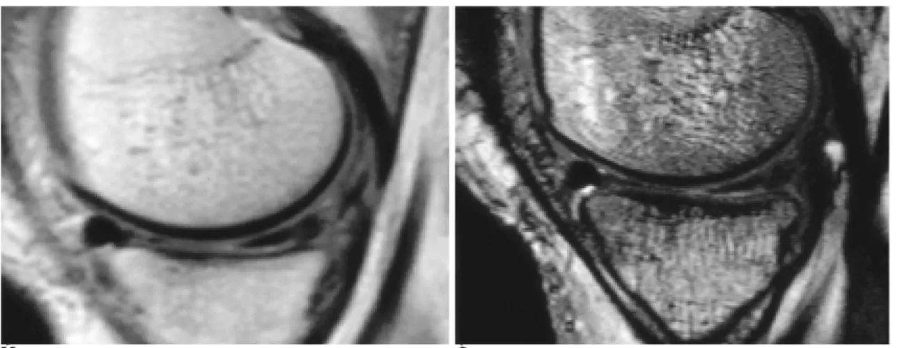 Fig. 1. Normal articular cartilage with tear of medial meniscus