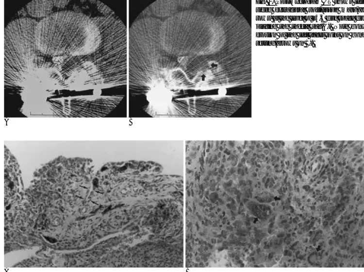 Fig. 2. Post-myelogram CT shows left- left-sided extradural soft-tissue  mass(ar-rows) at the level of L4-5 disc space  dis-placing the thecal sac(A)