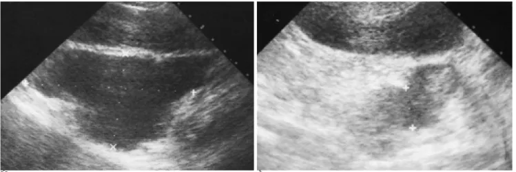 Fig. 2. A case of 41-year-old female patient with ovarian cyst which was previous TAH with RSO state.