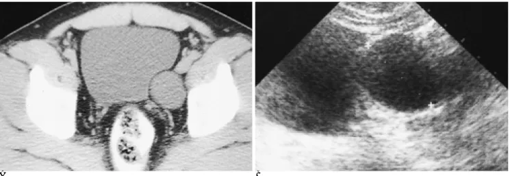 Fig. 3. A case of 42-year-old male with perivesical cyst.