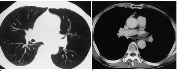 Fig. 1. CT scans with lung windows (A) and mediastinal windows (B) of a 64-year-old male patient with sputum show an endo- endo-bronchial mass with transendo-bronchial growth on the just proximal left main bronchus to its bifurcation