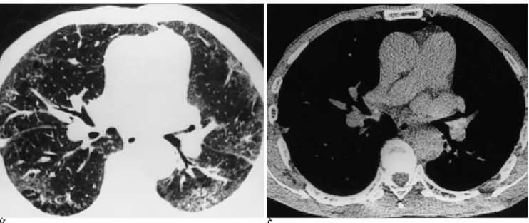 Fig. 2. CT scans with lung windows (A) and mediastinal windows (B) of a 59-year-old female patient who presented dyspnea on ex- ex-ertion show no evidence of endobronchial lesion on the right middle lobar bronchus on which a fine endobronchial nodule was  