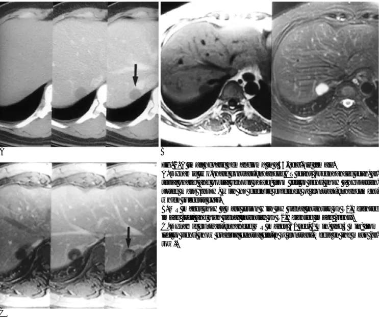 Fig. 2. A small hepatic hemangioma in a 43-year-old female.