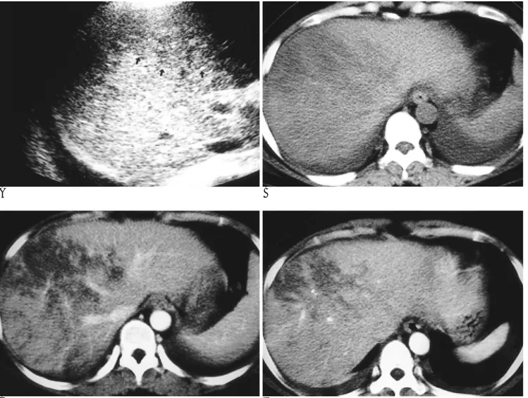 Fig. 1. A. Transverse US scan performed on postpartum second day demonstrates geographic hypoechoic areas with poorly de- de-fined margin in peripheral portion of right hepatic lobe(arrows).