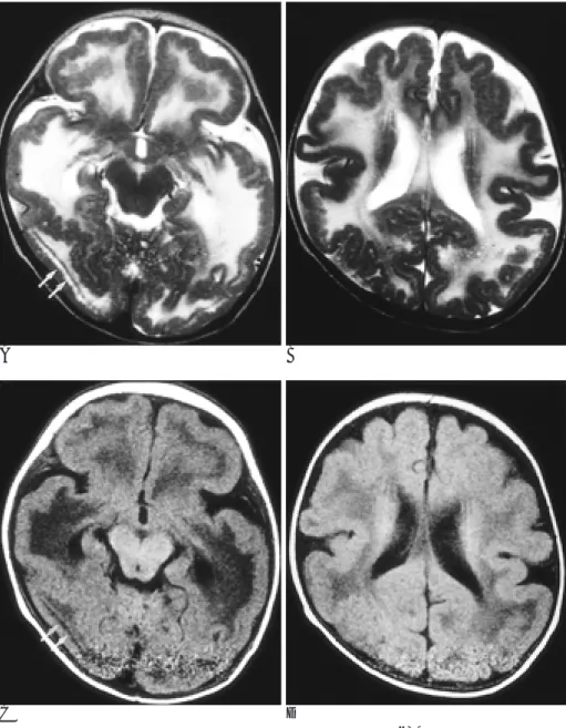 Fig. 1. Axial T2-weighted (A), (B) and T1-weighted (C),(D) MR images. The temporo-occipital lobes show thick cortices with smooth surface  (pachy-gyria) and some frontoparietal lobes show slightly thick cortices with  shal-low sulci (polymicrogyria)