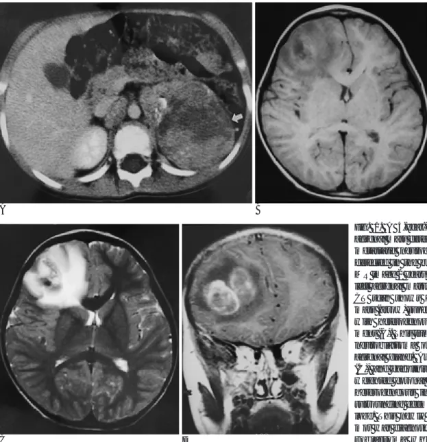 Fig. 1. A 4-year-old boy with a left adrenal mass detected on CT, in whom metastatic neuroblastoma was newly detected in the brain parenchyma on MR image 2 years after detection of the left adrenal mass