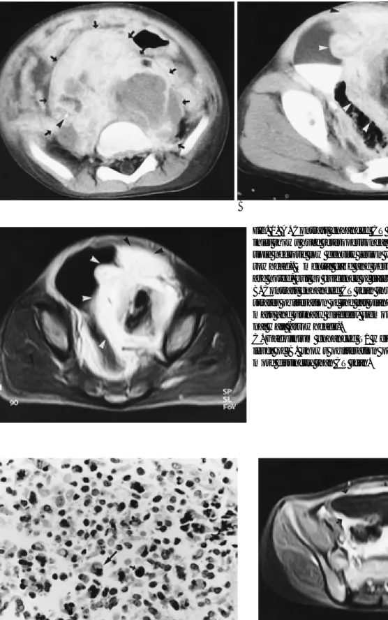 Fig. 2. Photomicrograph of histopathologic sections shows small cells with dark nuclei (small arrow) alternative with  larg-er cells with vesicular nuclei and abundant acidophilic  cyto-plasm (large arrow)