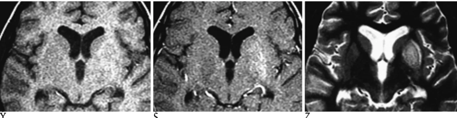Fig. 2. An 11-year-old man with neuropsychiatric lupus.