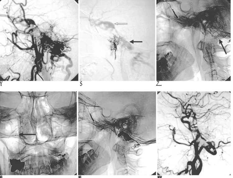 Fig. 1. DAVFs at marginal sinus with transvenous coil embolization through jugular vein.