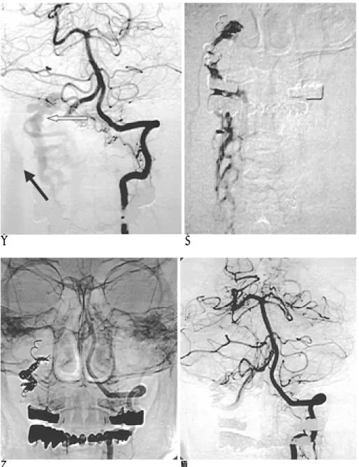 Fig. 2. Successful coil embolization through paravertebral venous plexus.