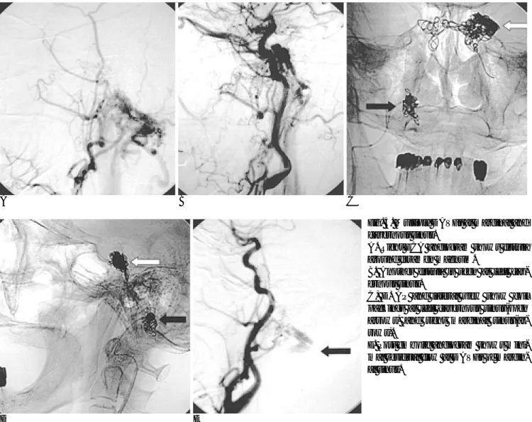 Fig. 3. Multiple DAVFs at marginal and cavernous sinus.