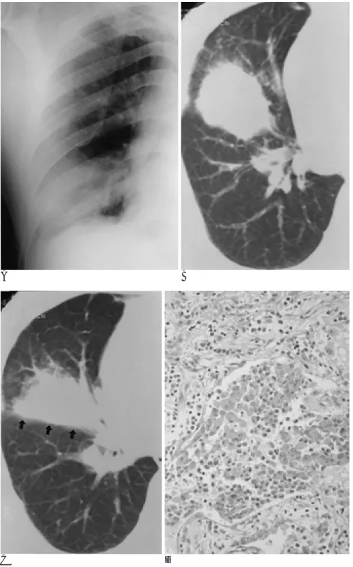 Fig. 1. A 74-year-old man with proved focal organizing pneumonia. 