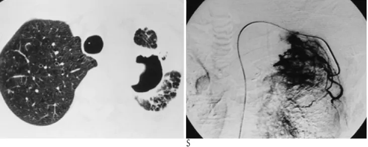 Fig. 1. 29-year-old man with partially treated pulmonary tuber- tuber-culosis and massive hemoptysis of about 500 cc for 24 hours.