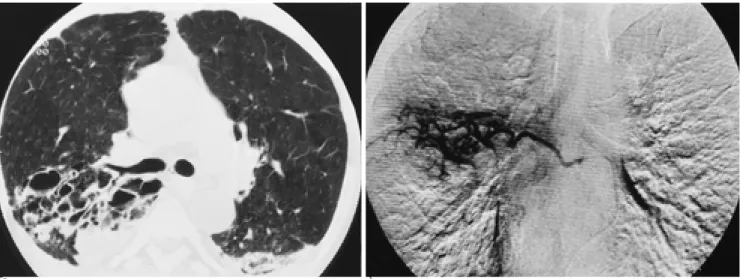 Fig. 3. 60-year-old man with clinically fully treated pulmonary tuberculosis and massive hemoptysis of about 300 cc for 12 hours.