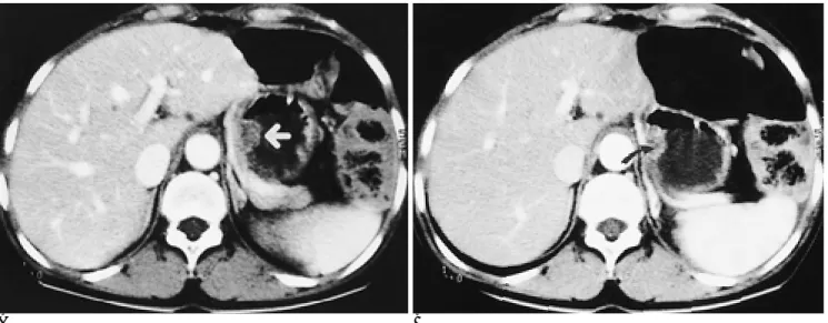 Fig. 2. A 67-year-old man with recurred cancer at gastric stump.