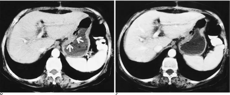 Fig. 4. A 66-year-old woman with gastritis.