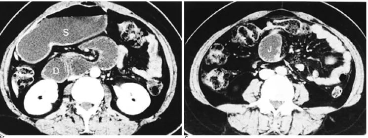Fig. 2. 40-year-old woman with vomiting and abdominal distension. 