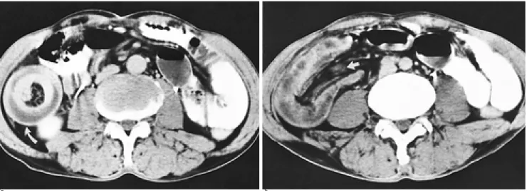 Fig. 4. 48-year-old man with abdominal pain and severe ten- ten-derness. 