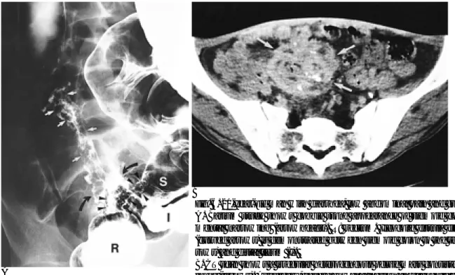 Fig. 6. 21-year-old man with diarrhea, low abdominal pain and guarding. 