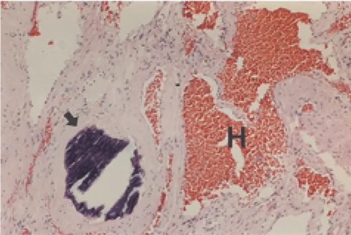 Fig. 4. The tumor is composed of many dilated, vascular spaces lined by a single layer of endothelial cells(H)